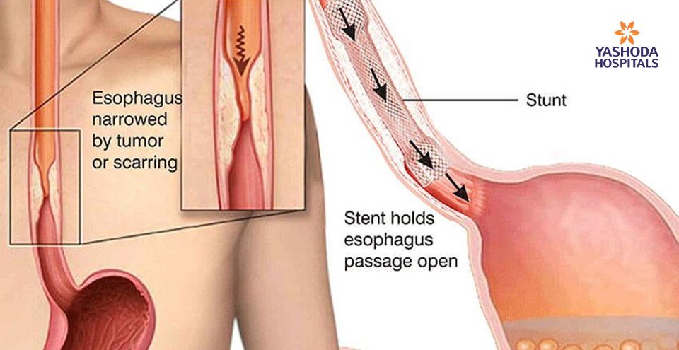 Gastrointestinal Stents: Safe and Effective alternative to Surgery or Repetitive Endoscopic Procedures