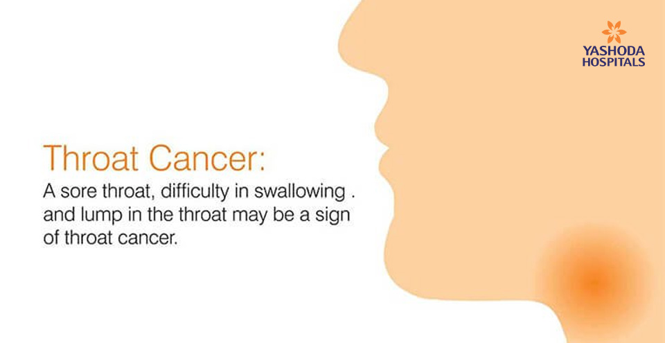 Throat Cancer: A sore throat, difficulty in swallowing and lump in the throat may be a sign of throat cancer