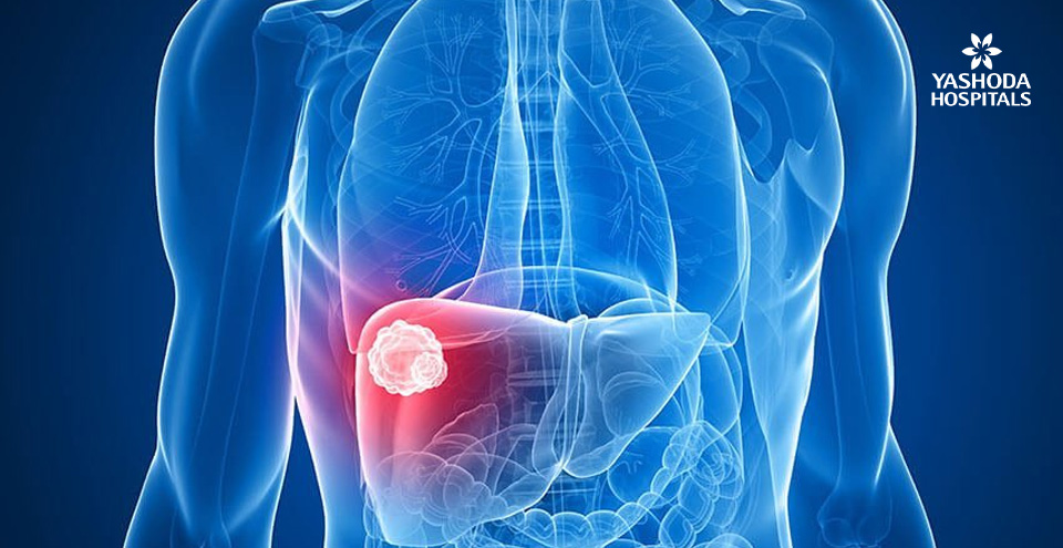 How can one survive liver cancer ?