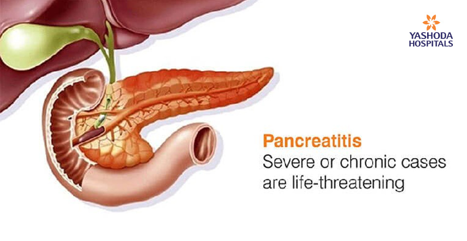 Pancreatitis: Severe or chronic cases are life-threatening