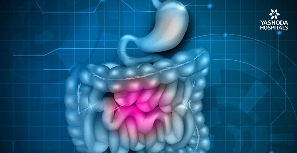 Painful cramps and constipation? It could be Irritable Bowel Syndrome (IBS)