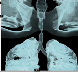 Interventional Pulmonology