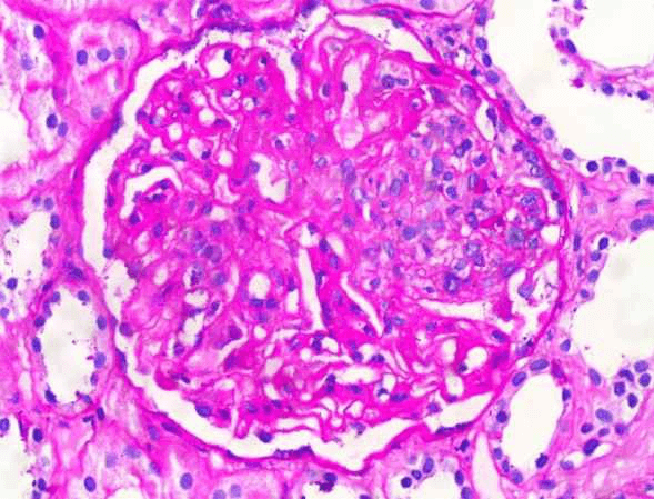 Glomerus with diffuse masement membrane