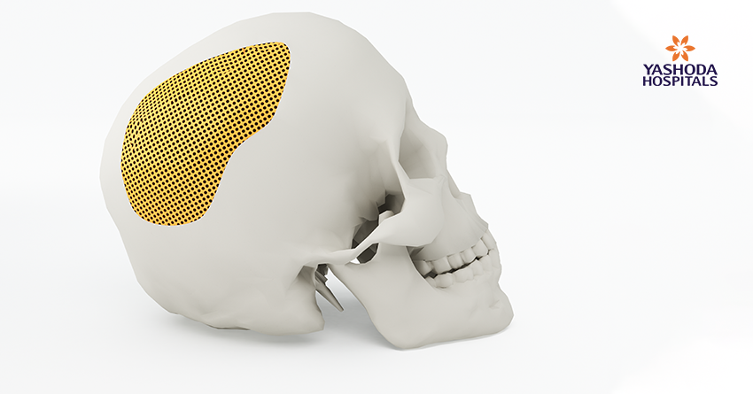 Artificial Skull Bone Using 3D Printing Technology
