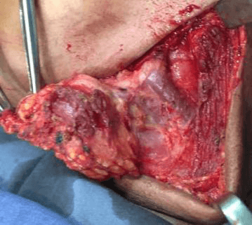common tumor of the salivary gland