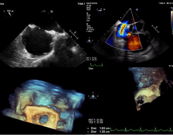 2D echocardiography images measured ASD as 11mm and 3D-TEE gave an accurate measure
