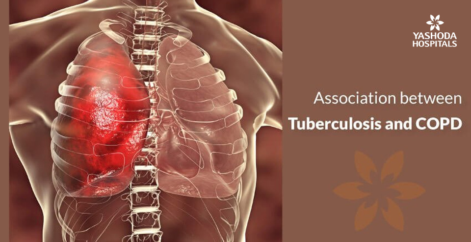 Does tuberculosis cause COPD, pulmonary fibrosis or restrictive lung disease?