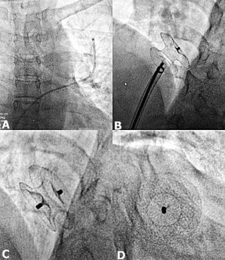 Step-wise ASD device closure showing a catheter across the ASD placed in the left upper pulmonary vein which exchanged using Amplatzer stiff wire