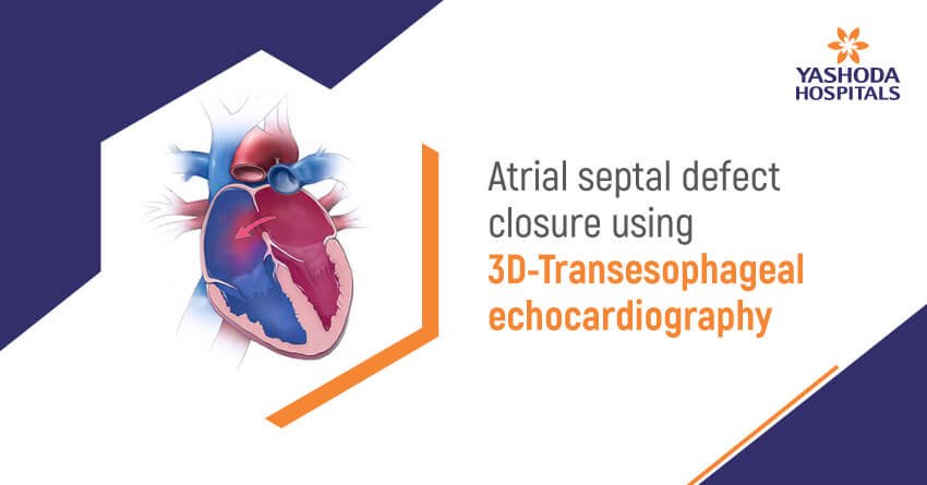 Three-Dimensional Trans-Esophageal Echocardiography [3D-TEE] guided device closure of the atrial septal defect