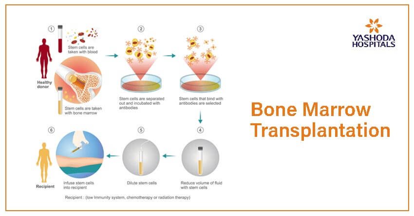 Yashoda’s Advanced Bone Marrow Transplant Institute Creates Medical Landmarks
