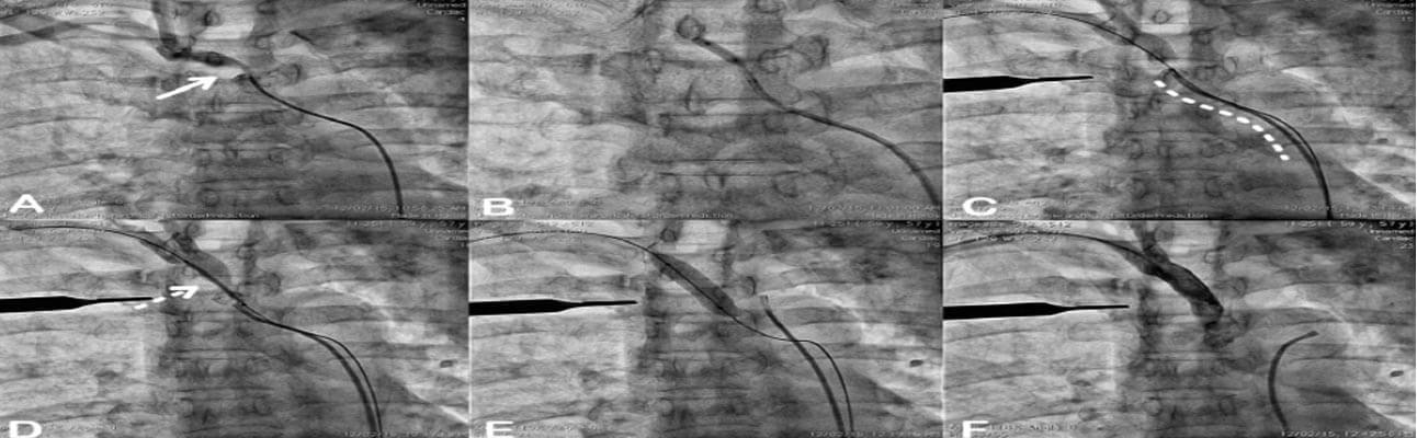 combined approach for Right innominate artery PTA