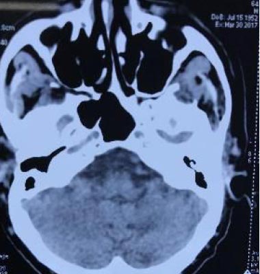 CT brain 1.5 years later