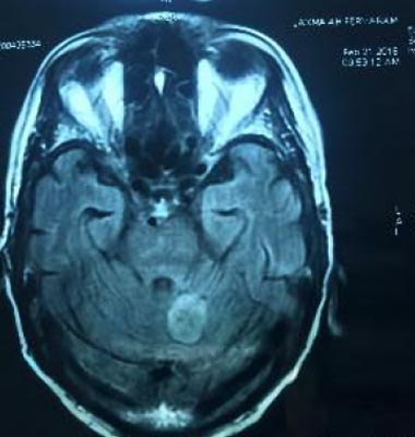 MRI brain 4 months later