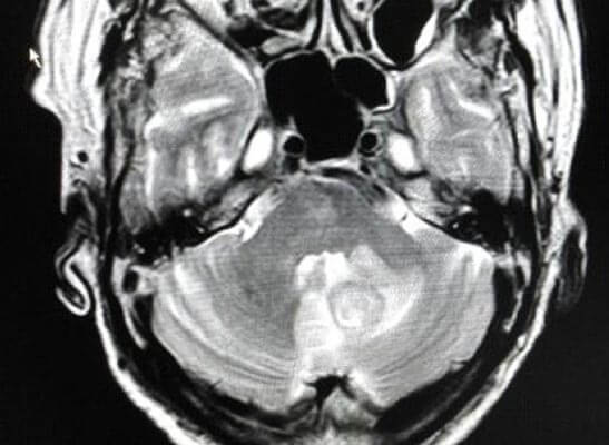 MRI brain at presentation