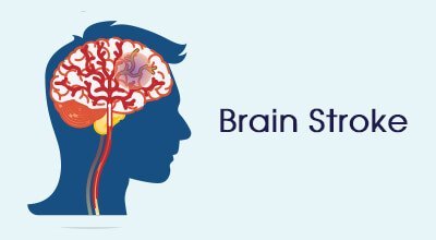 Brain Stroke Infographics