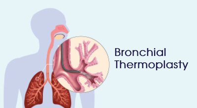 Bronchial Thermoplasty Infographics