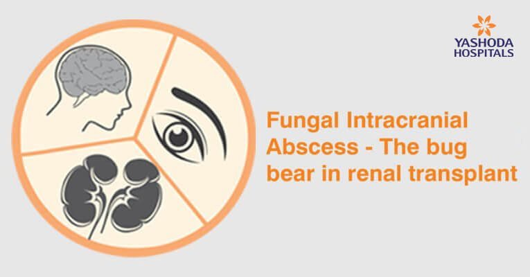 Fungal Intracranial Abscess – The bugbear in renal transplant