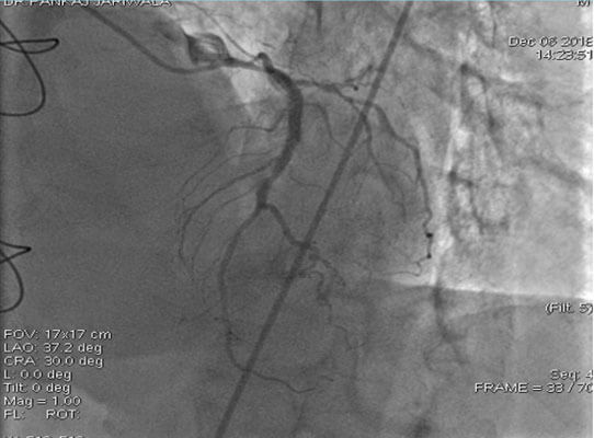 cag: sigificant stenosis of lmca across the lcx with stenosis of osteal lcx.