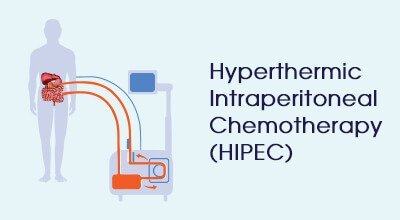 hyperthermic intraperitoneal chemotherapy Infographics HIPEC