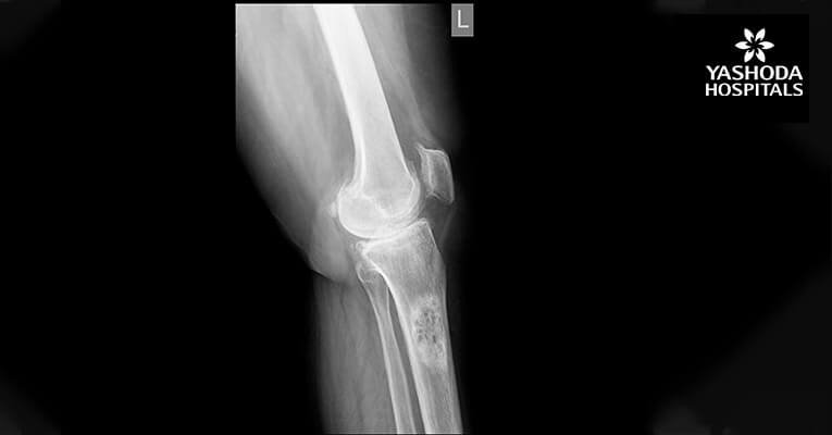 Solitary Huge Osteochondroma of Proximal Femur in a Young Adult Without Malignant Transformation