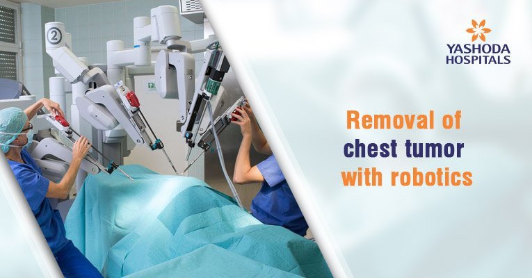 Robotic cancer surgery for excision of chest tumor