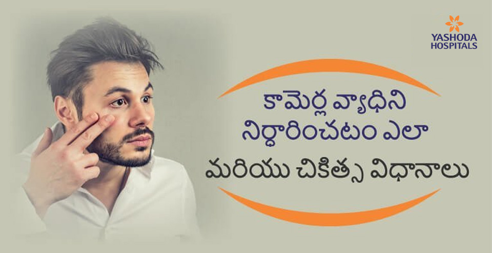 కామెర్ల వ్యాధి లక్షణాలు మరియు చికిత్స విధాన వివరాలు