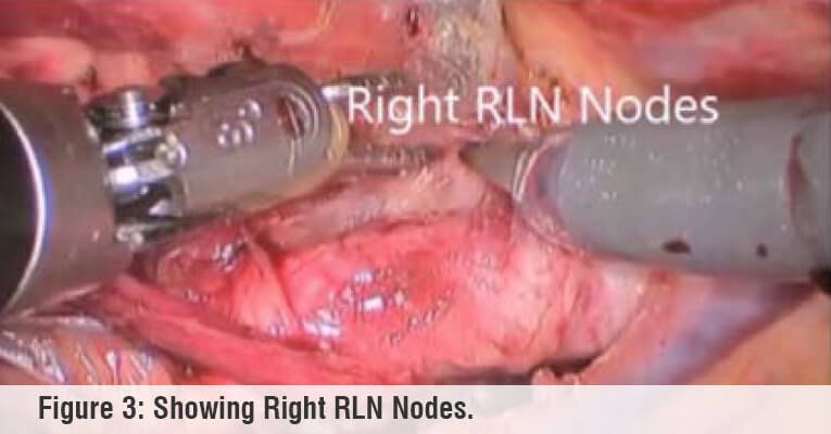 right rln nodes robotic surgery