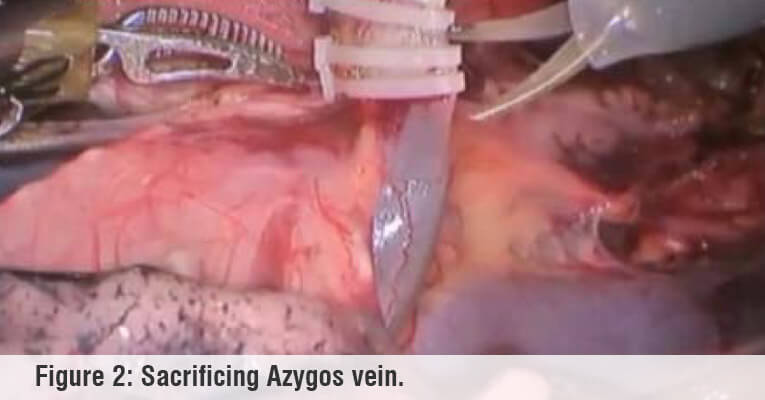 sacrificing azygos vein robotic surgery