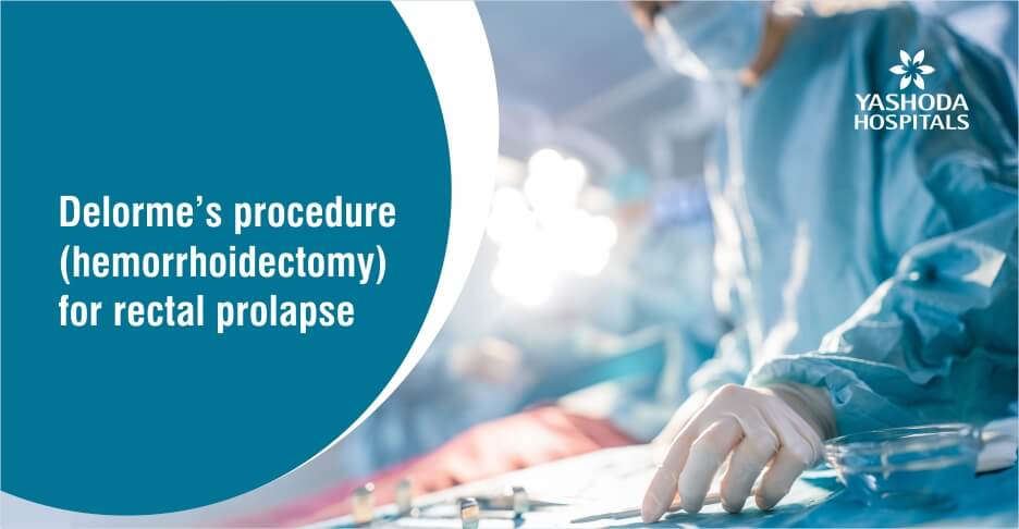 Delorme’s procedure (hemorrhoidectomy) for rectal prolapse