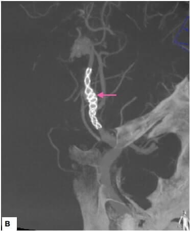 Flow diverter placement cerebral artery aneurysm