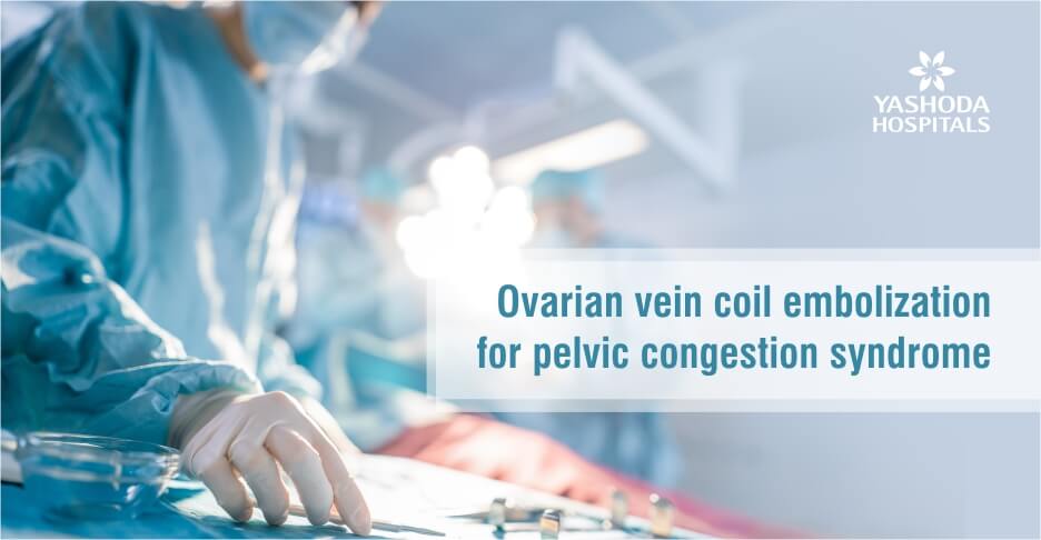 Ovarian vein coil embolization for pelvic congestion syndrome