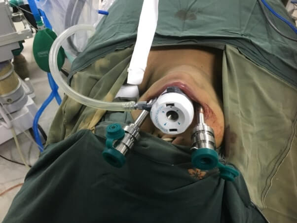 Transoral robotic thyroidectomy - a neck scarless procedure of cosmesis with cure