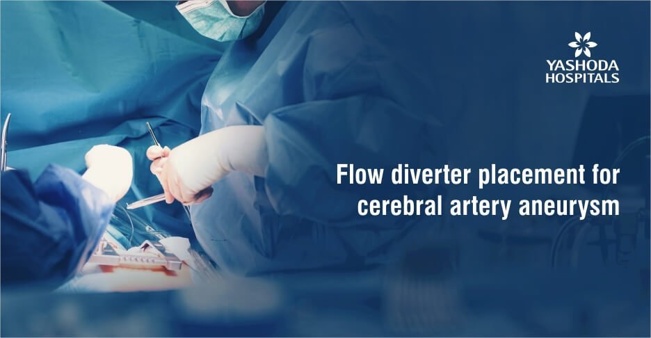 Flow diverter placement for cerebral artery aneurysm