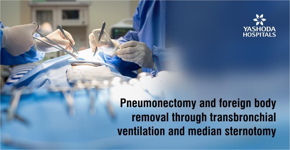 Pneumonectomy and foreign body removal through transbronchial ventilation and median sternotomy