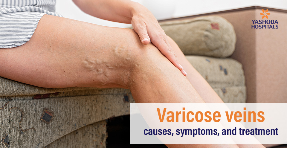 Varicose veins: causes, symptoms, and treatment