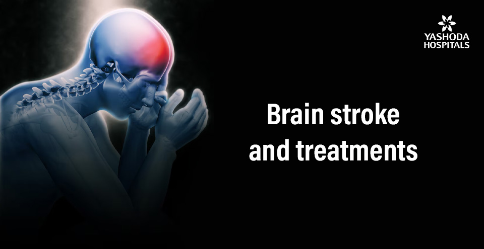 Brain stroke and treatments