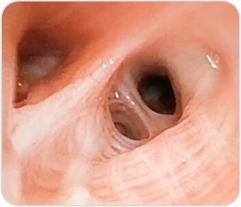 Bronchial Thermoplasty case-study