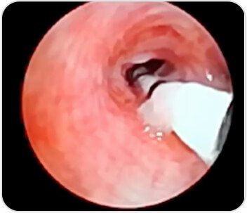 Bronchial Thermoplasty case-study