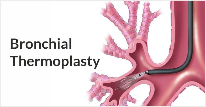 Bronchial Thermoplasty
