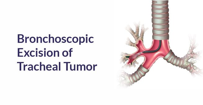 Bronchoscopic Excision of Tracheal Tumor