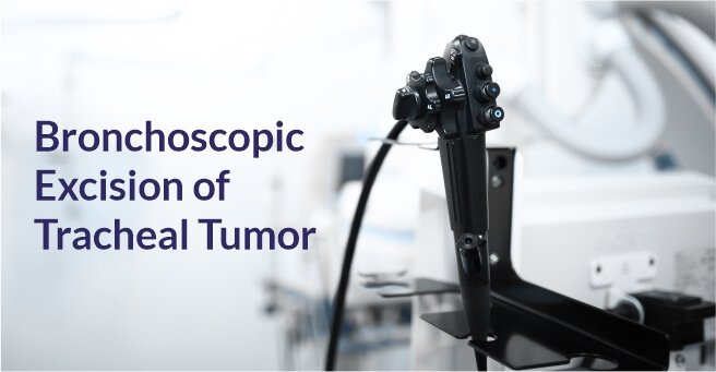 Bronchoscopic Excision of Tracheal Tumor