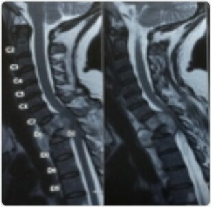 MRI – D1,D2 involved with complete collapse of D2 collection compressing the cord
