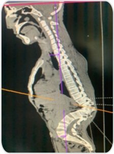 Pre-operative ct scan showing deformed spine of the patient with VRT showing unsegmented posterior hemivertebra