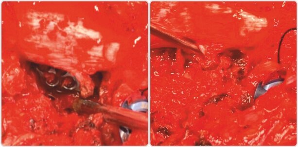 Intra op pictures showing Mesh cage filled with local bone graft as anterior support