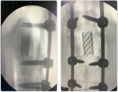 C-arm images of mesh cage and pedicle screw fixation