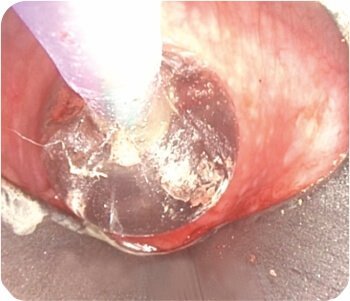 Balloon Dilatation of Tracheal Stenosis