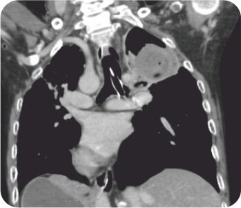 Bronchial Artery Embolisation and Sphigot Insertion of Bronchus