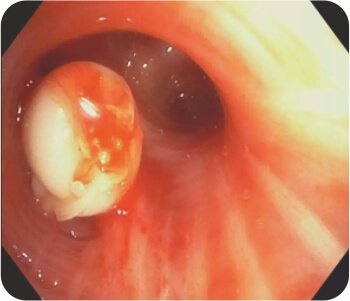 Bronchial Artery Embolisation and Sphigot Insertion of Bronchus