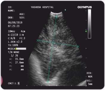 Endobronchial Ultrasound +Transbronchial Needle Aspiration for Lung Tumour
