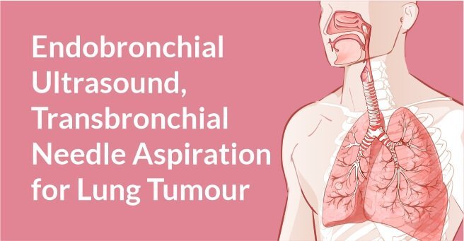 Endobronchial Ultrasound – Transbronchial Needle Aspiration for Lung Tumour
